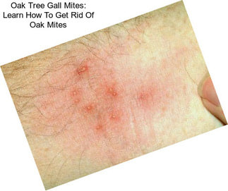 Oak Tree Gall Mites: Learn How To Get Rid Of Oak Mites